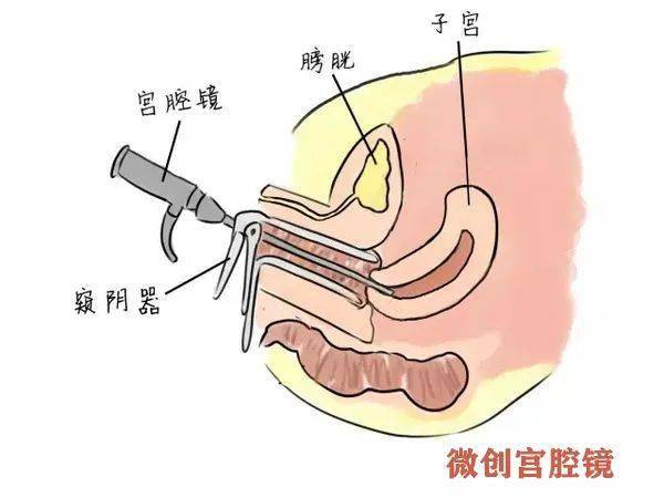 宫形环取环视频_宫型环取环痛不痛_宫型环是最难取的环吗